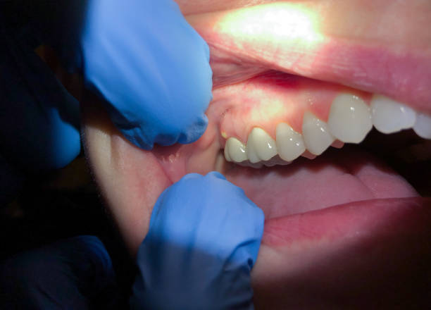 Best Emergency Gum Treatment in Columbus, WI
